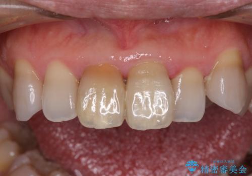 変色した前歯 オールセラミッククラウンにより審美歯科治療の治療前