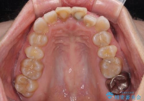 変色した前歯 オールセラミッククラウンにより審美歯科治療の治療前