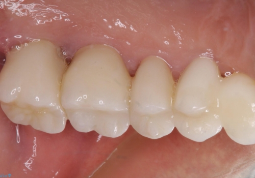 歯肉が腫れて出血する 奥歯の歯周病治療の治療後