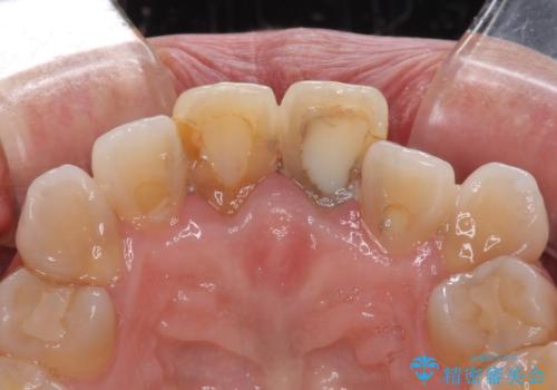 変色した前歯 オールセラミッククラウンにより審美歯科治療の治療前