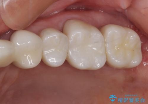 歯肉が腫れて出血する　奥歯の歯周病治療の症例 治療後
