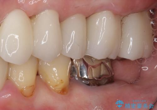 歯肉が腫れて出血する 奥歯の歯周病治療の治療後