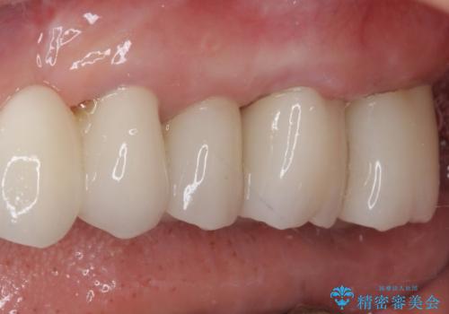 歯肉が腫れて出血する 奥歯の歯周病治療の治療後