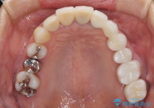 歯肉が腫れて出血する 奥歯の歯周病治療の治療後