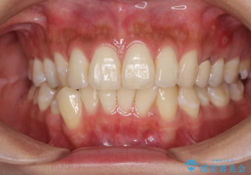 八重歯の再矯正　インビザラインでストレスなく矯正治療の症例 治療前