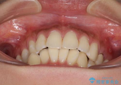 八重歯の再矯正　インビザラインでストレスなく矯正治療の治療前