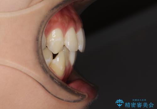八重歯の再矯正 インビザラインでストレスなく矯正治療の治療前