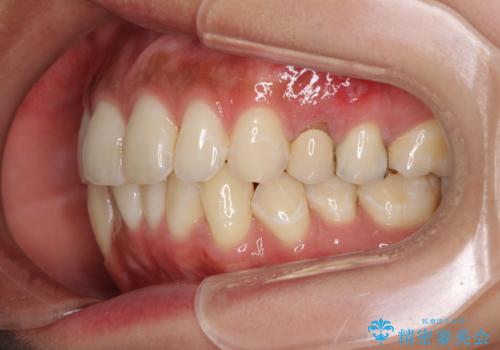 八重歯の再矯正　インビザラインでストレスなく矯正治療の治療前
