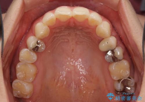 八重歯の再矯正 インビザラインでストレスなく矯正治療の治療前