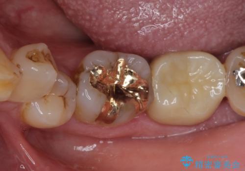 銀歯や虫歯を治したい ゴールドインレーによるむし歯治療の治療後