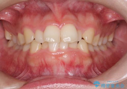 インビザラインでの前歯のガタガタの矯正の治療前