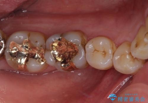銀歯や虫歯を治したい　ゴールドインレーによるむし歯治療の治療後