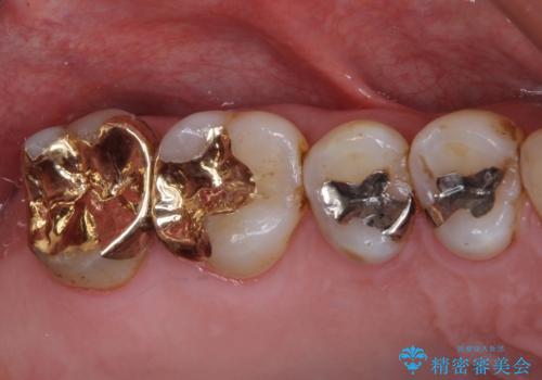 銀歯や虫歯を治したい　ゴールドインレーによるむし歯治療の症例 治療後