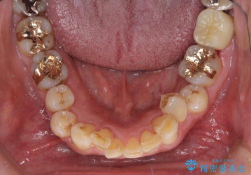 銀歯や虫歯を治したい ゴールドインレーによるむし歯治療の治療後