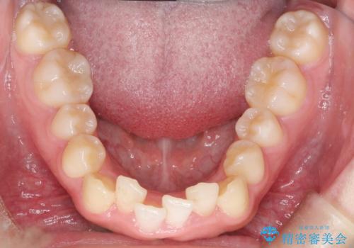 インビザラインでの前歯のガタガタの矯正の治療前