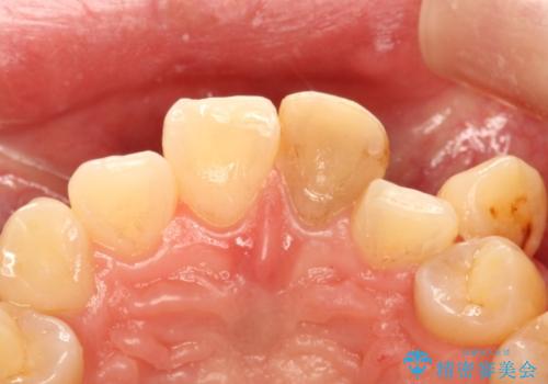 前歯を綺麗にしたい オールセラミッククラウンの治療前