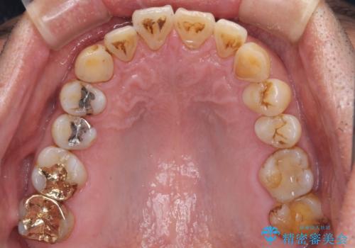 銀歯や虫歯を治したい ゴールドインレーによるむし歯治療の治療後