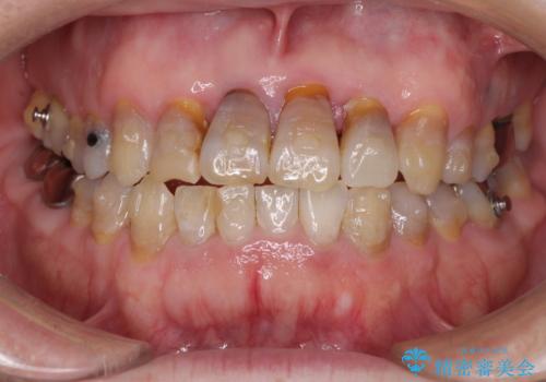 上顎の狭窄歯列 インビザラインによる拡大矯正の治療中