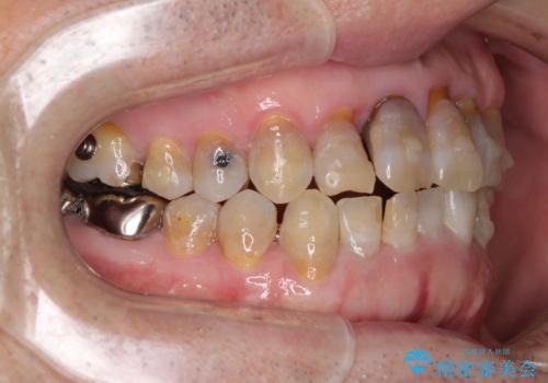 上顎の狭窄歯列 インビザラインによる拡大矯正の治療中