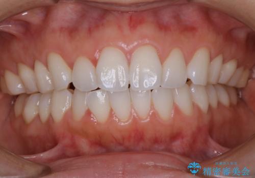 ホームホワイトニング前にPMTCできれいにの治療前