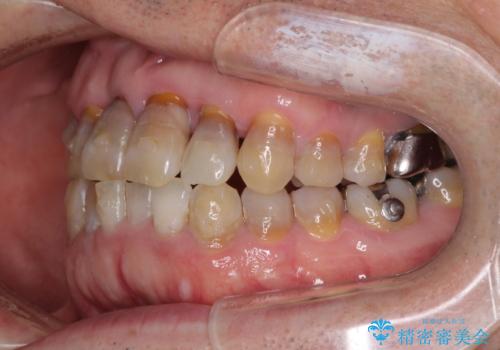 上顎の狭窄歯列 インビザラインによる拡大矯正の治療中