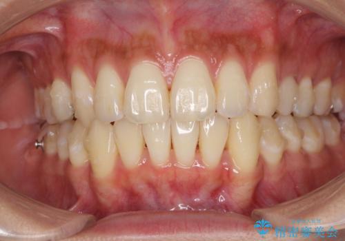 八重歯の再矯正 インビザラインでストレスなく矯正治療の治療中