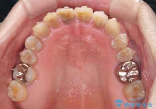 上顎の狭窄歯列 インビザラインによる拡大矯正の治療中