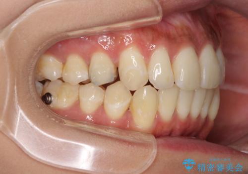 八重歯の再矯正 インビザラインでストレスなく矯正治療の治療中