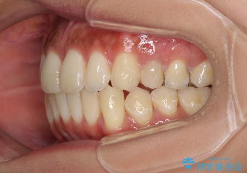 八重歯の再矯正 インビザラインでストレスなく矯正治療の治療中