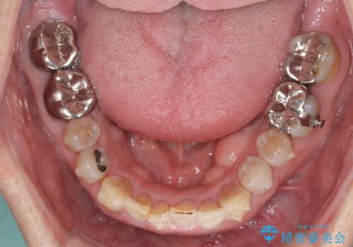 上顎の狭窄歯列　インビザラインによる拡大矯正の治療中