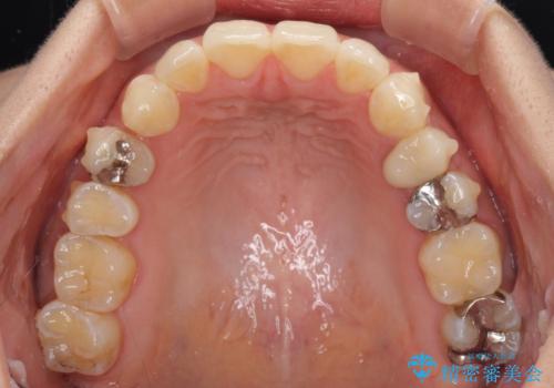 八重歯の再矯正 インビザラインでストレスなく矯正治療の治療中