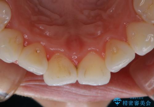 ホームホワイトニング前にPMTCできれいにの治療前