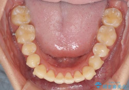 八重歯の再矯正　インビザラインでストレスなく矯正治療の治療中