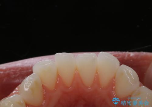 ホームホワイトニング前にPMTCできれいにの治療前