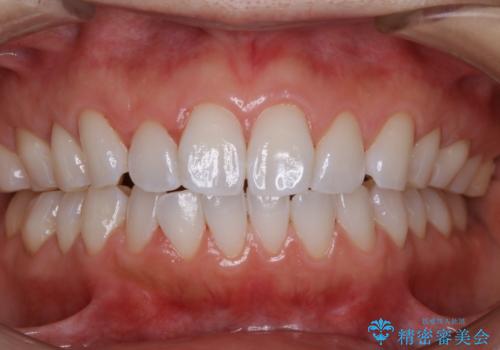 ホームホワイトニング前にPMTCできれいにの治療後