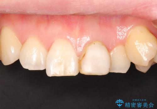 前歯を綺麗にしたい オールセラミッククラウンの治療前