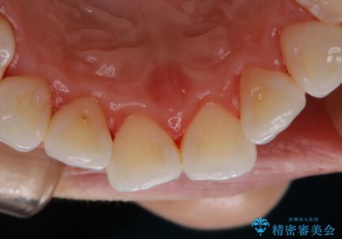 ホームホワイトニング前にPMTCできれいにの治療後