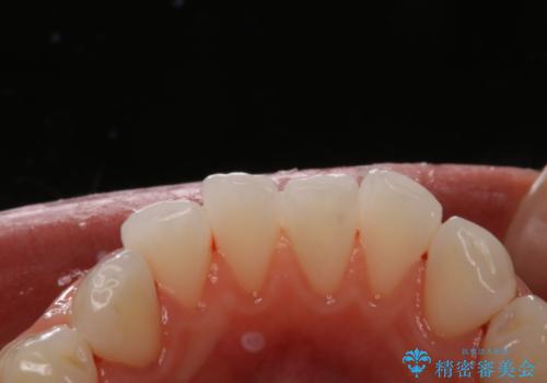 ホームホワイトニング前にPMTCできれいにの治療後