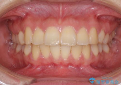 部分矯正で出っ歯になった 出っ歯改善の抜歯矯正の治療前