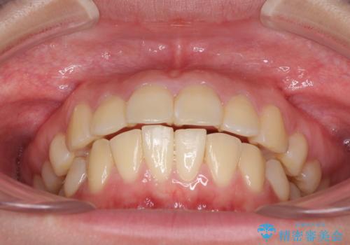 部分矯正で出っ歯になった 出っ歯改善の抜歯矯正の治療前