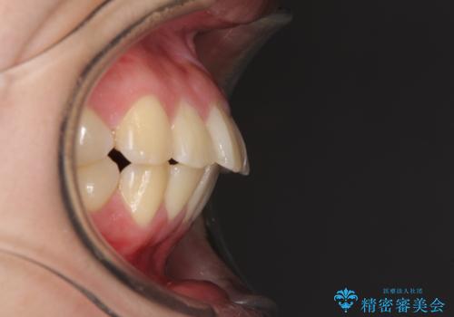 部分矯正で出っ歯になった 出っ歯改善の抜歯矯正の治療前