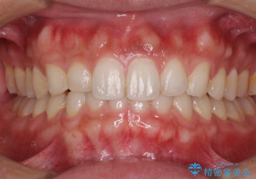 細かい隙間にものがはさまる インビザラインによる矯正治療の症例 治療後