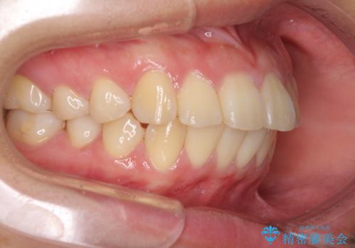 部分矯正で出っ歯になった 出っ歯改善の抜歯矯正の治療前
