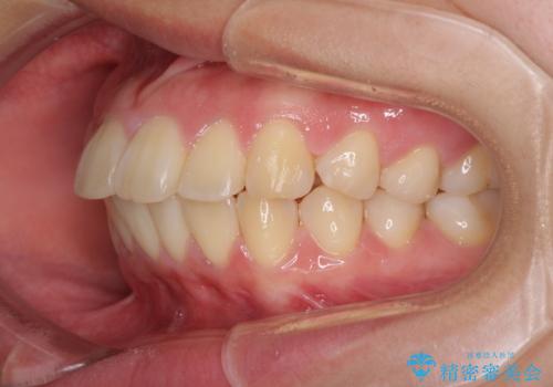 部分矯正で出っ歯になった 出っ歯改善の抜歯矯正の治療前