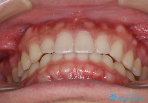 細かい隙間にものがはさまる インビザラインによる矯正治療の治療後