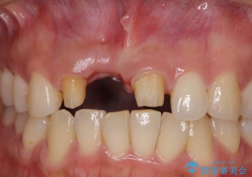 治療途中で放置した前歯 オールセラミックブリッジの治療前