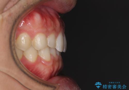 細かい隙間にものがはさまる インビザラインによる矯正治療の治療後