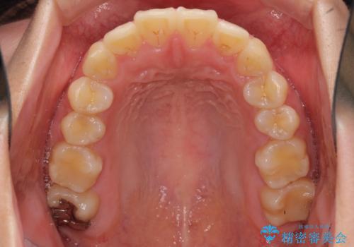 部分矯正で出っ歯になった　出っ歯改善の抜歯矯正の治療前