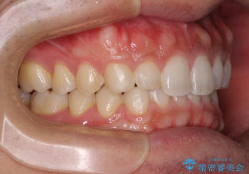 細かい隙間にものがはさまる インビザラインによる矯正治療の治療後