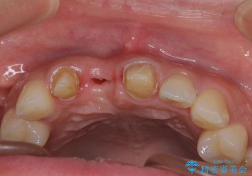 治療途中で放置した前歯 オールセラミックブリッジの治療前